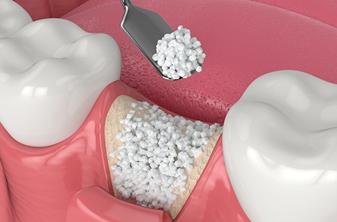 Illustration of bone grafting material being placed in the jawbone after a tooth extraction
