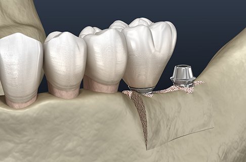 Illustration of two dental implants in an expanded jawbone