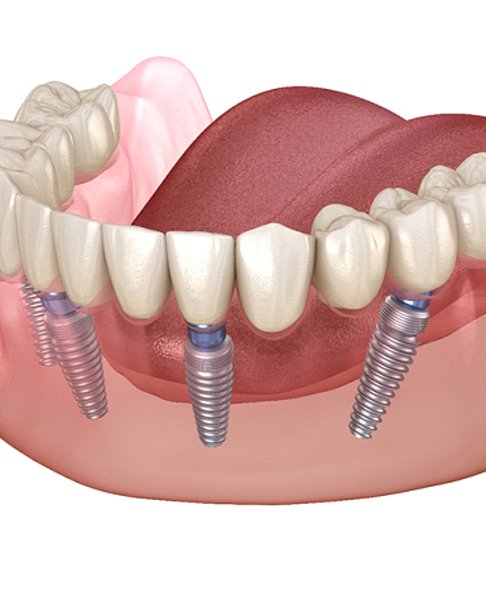 Illustration of All on 4 implant denture on the lower arch