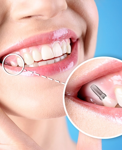 Close up of a woman’s smile with a dental implant