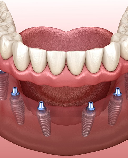 Illustration of an implant denture supported by six implants