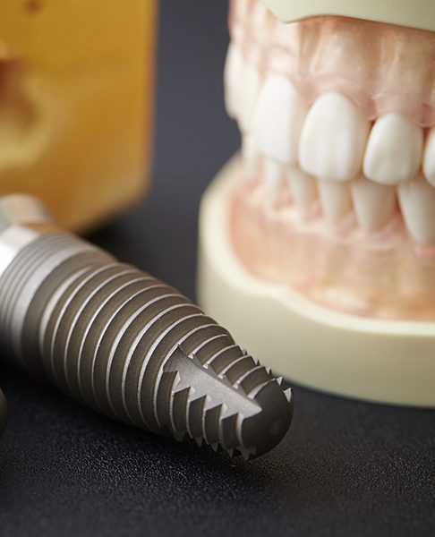 Close up of dental implants next to a model of the teeth
