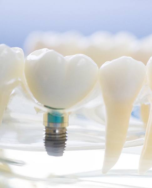 Model of jaw with a dental implant