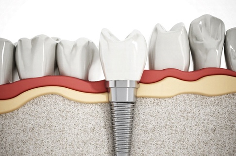 Illustration of a dental implant integrated with surrounding bone