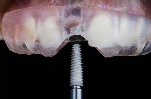 Model of a dental implant being placed in the mouth with a surgical guide