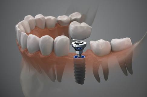 Illustration of a dental crown over a dental implant