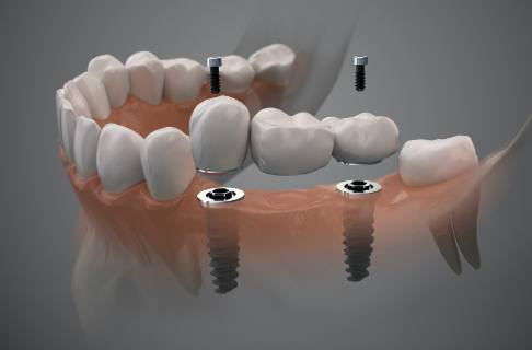 Illustration of a dental bridge over two dental implants