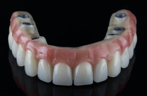 Model of an implant denture
