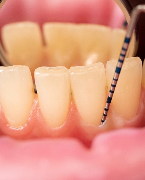 Close up of dental tools measuring gum pockets