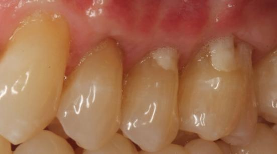 Teeth and roots after treatment