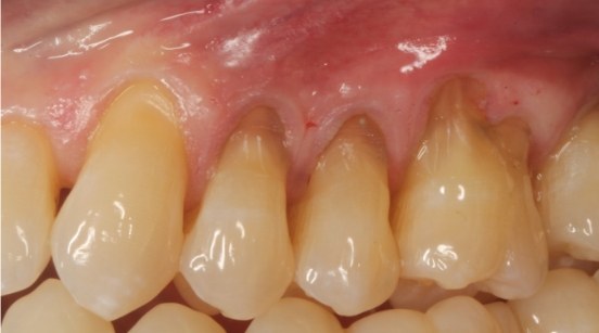 Teeth before treatment
