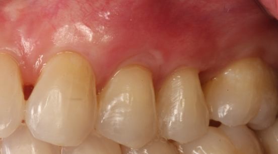 Teeth correctly sized after treatment