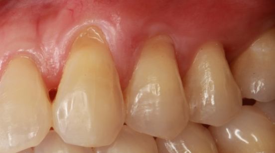 Teeth unusually long prior to treatment