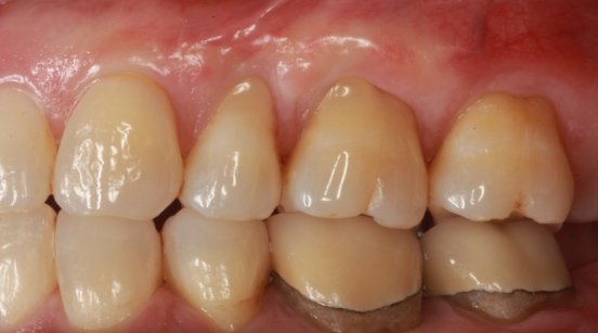 Gum recession leaving a bit too much tooth visible