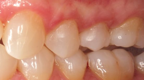 Tooth with root properly covered by gums