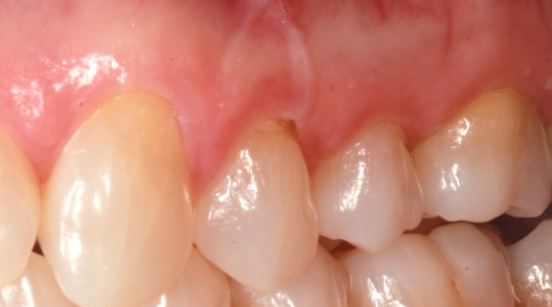 Tooth with root slightly exposed