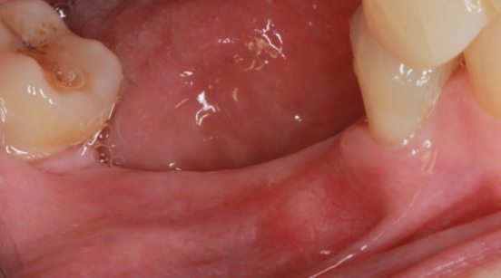Gums after treatment