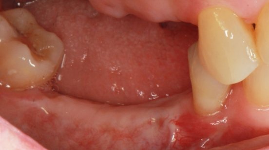 Gums prior to treatment