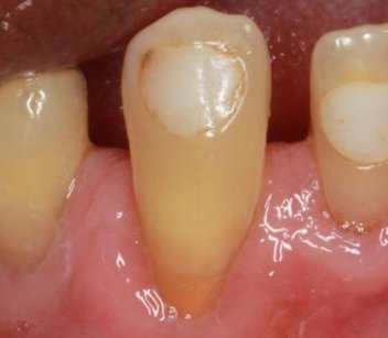 Close-up of tooth after gum grafting
