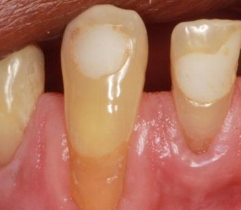 Tooth that looks long due to gum recession