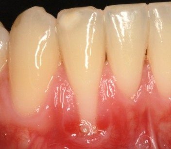 Multiple teeth with one that looks longer than the others
