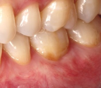 Shot of teeth with exposed roots now covered by gums