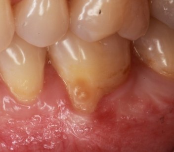 Close-up of tooth with exposed root