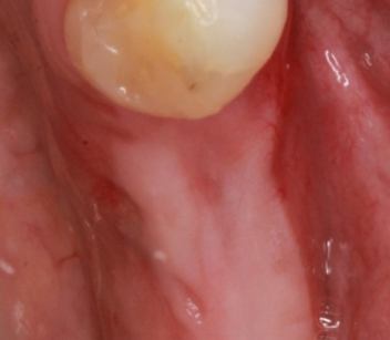 Gums after issue has been treated