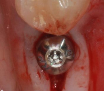 Exposed dental implant