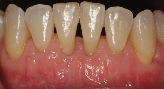 Teeth and gums before treatment