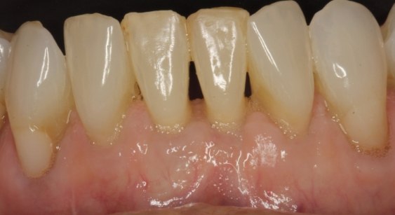Close up of teeth after dental treatment