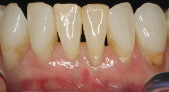 Close up of teeth before dental treatment