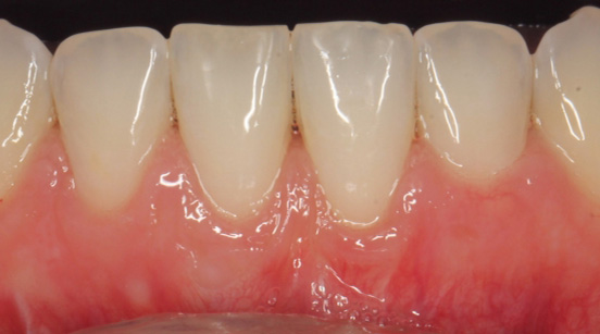 Teeth after gum recession has been corrected