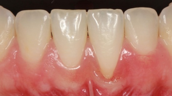 Teeth with roots visible due to gum recession