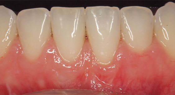 After picture showing proportionate teeth and gums