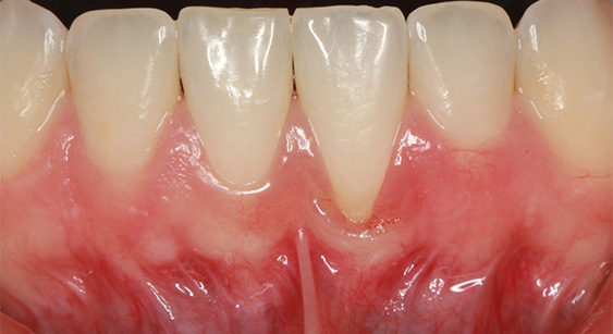 Before picture showing a longer looking tooth