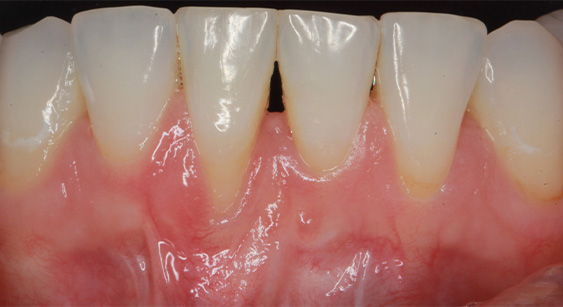 Close up of dull teeth