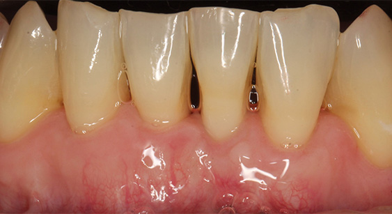 Close up of patient's teeth after treatment