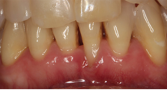 Close up of patient's teeth prior to treatment