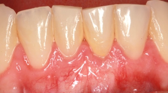 Close up of teeth after gum recession has been corrected