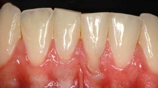 Close up of teeth with severe gum recession