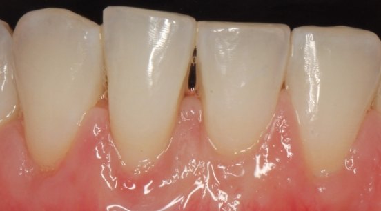 After picture of tooth with root covered