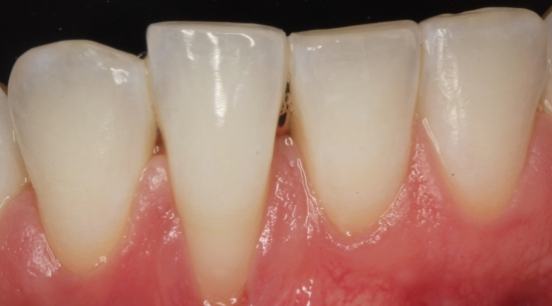 Before picture of unusually long tooth