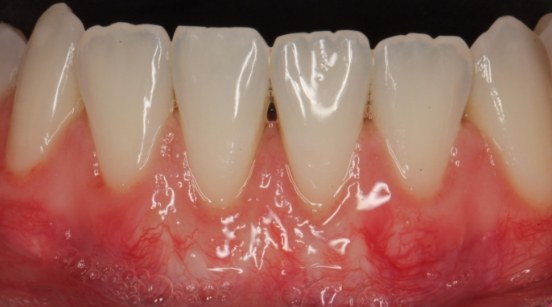 More proportional looking teeth after gums recession has been corrected