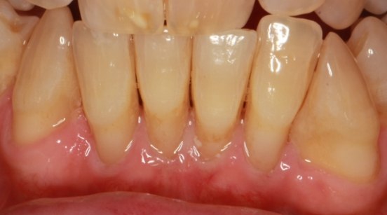 Upper and lower rows of teeth after treatment