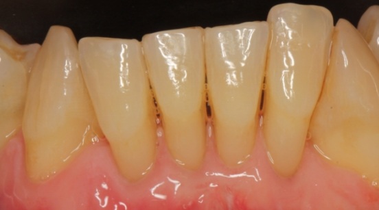 Lower teeth before treatment