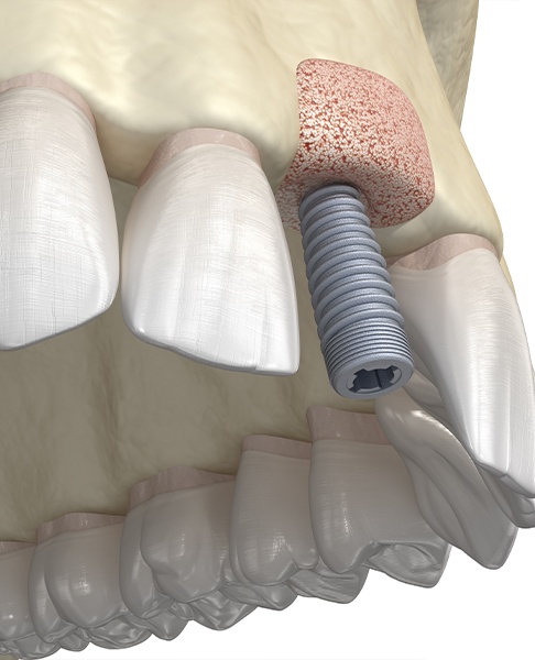 Illustration of a mouth with a dental implant post placed into a bone graft