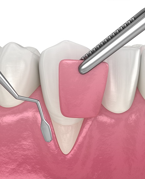 Illustration of a mouth during the gum grafting process