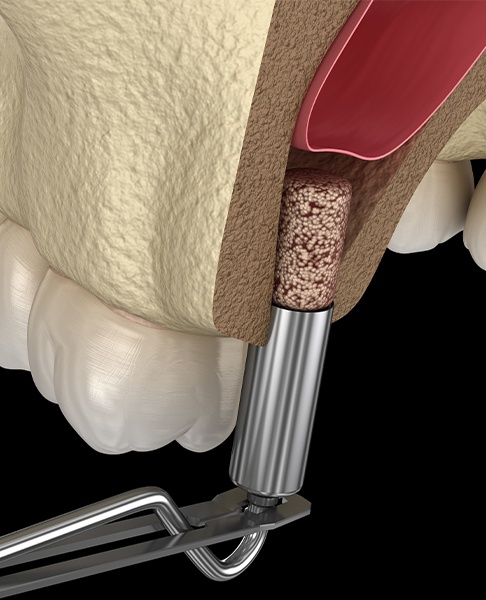 Illustrated sinus lift bone grafting process