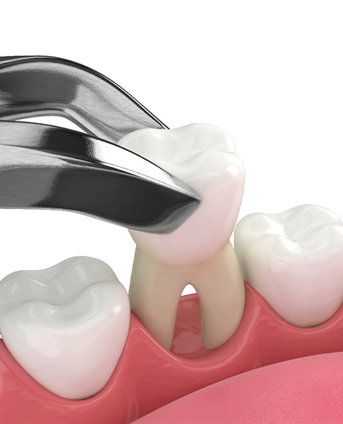 Illustration of a tooth being removed with forceps